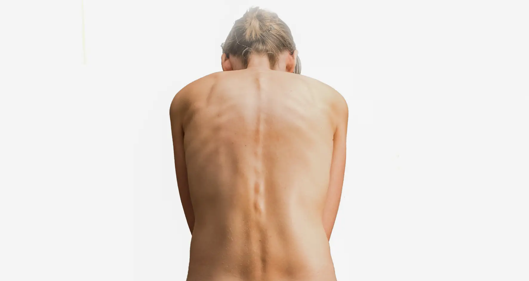 Scoliosis & Kyphosis Correction