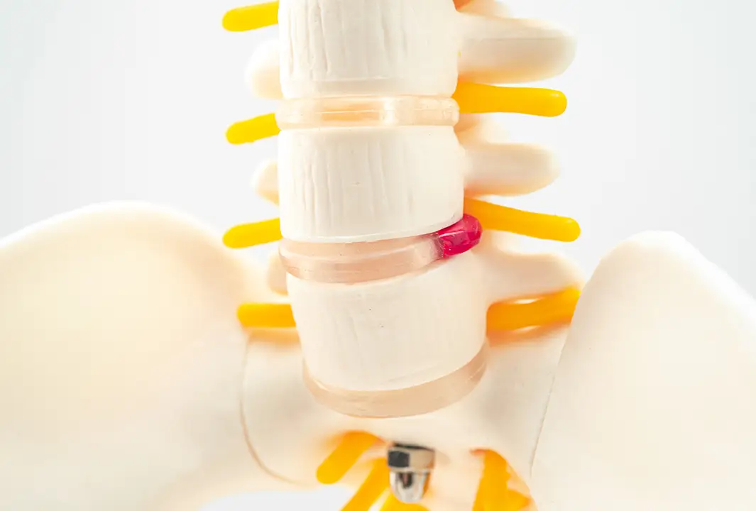 Posterior Disc Bulge Care